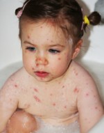 Chicken pox