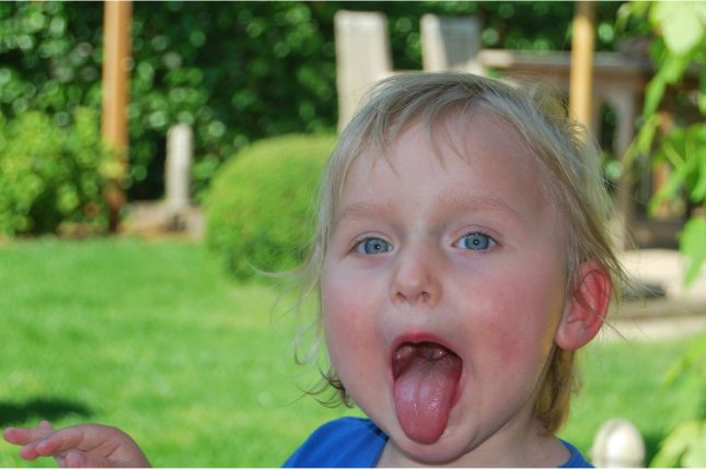 Hand, foot and mouth disease Hand, foot and mouth disease - Signs and symptoms